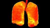 Scan image of lungs, brightly colored to show anatomy.
